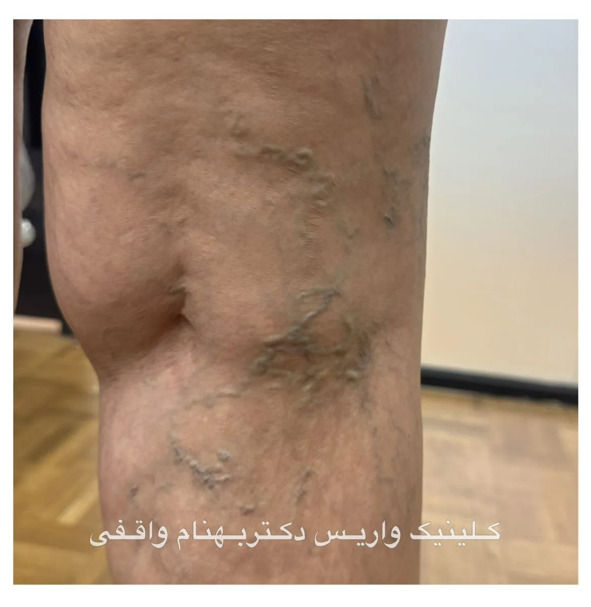 رگ های آبی و یرجسته روی پا