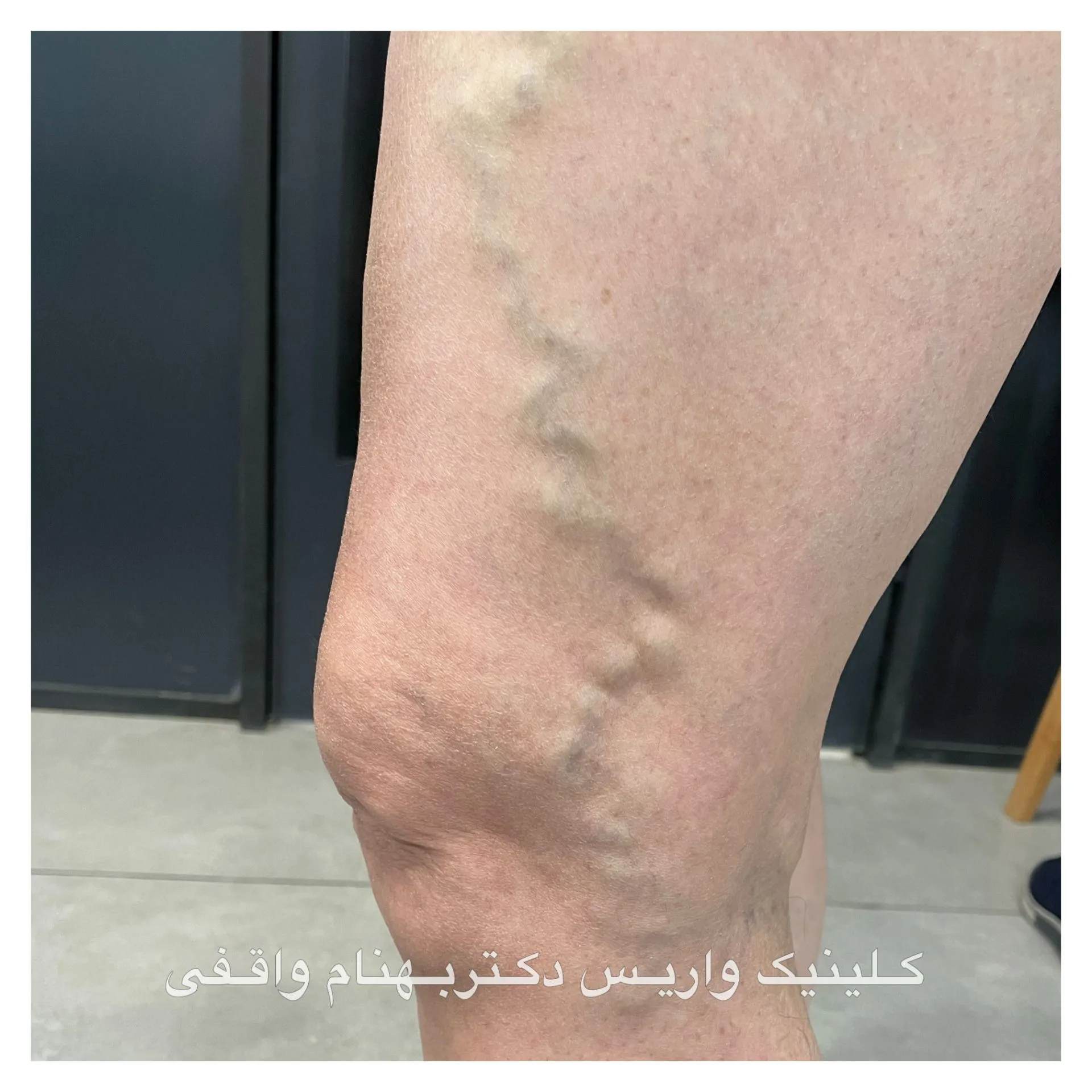 عکس واریس طنابی ران پا