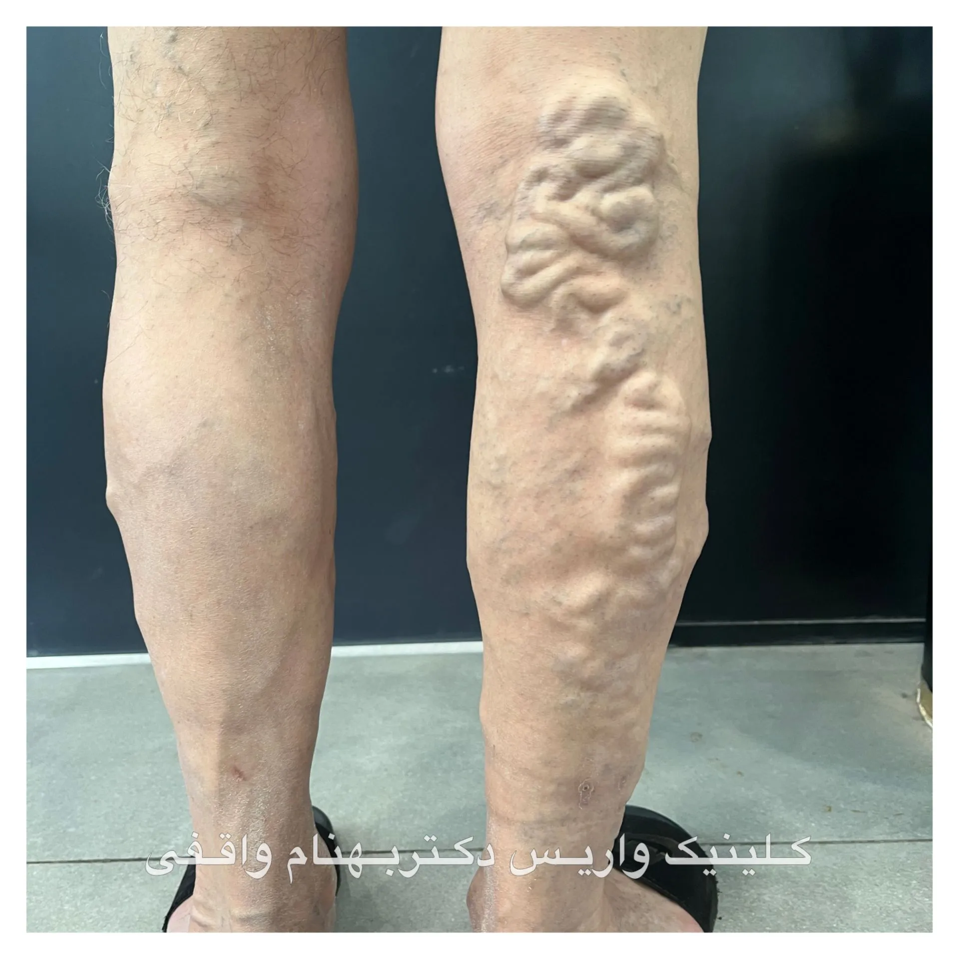 عکس واریس طنابی