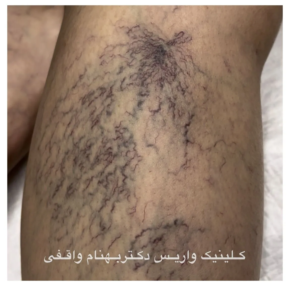 عکس واریس عنکبوتی