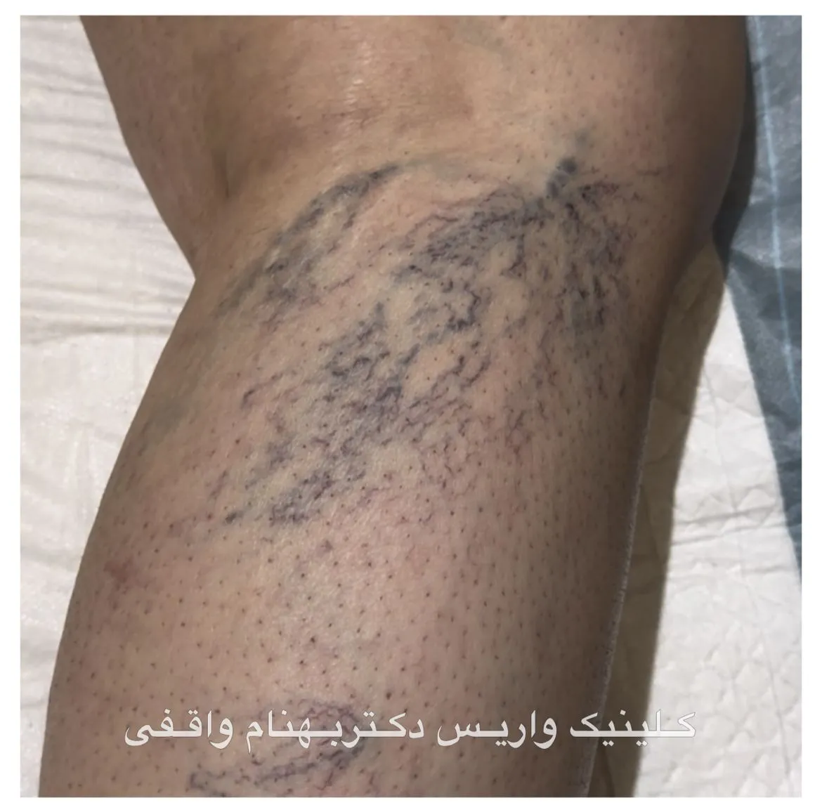 عکس واریس خفیف