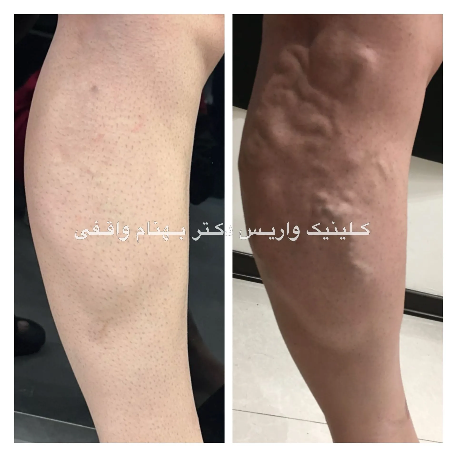 عکس واریس پشت پا