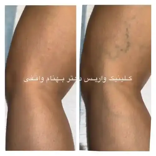 قبل و بعد از اسکلروتراپی