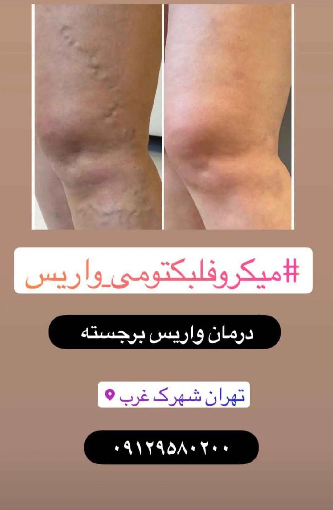 عکس درمان واریس پا با میکروفلبکتومی