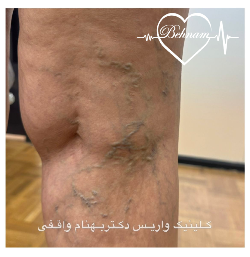 واریس و رگ برجسته پشت زانو