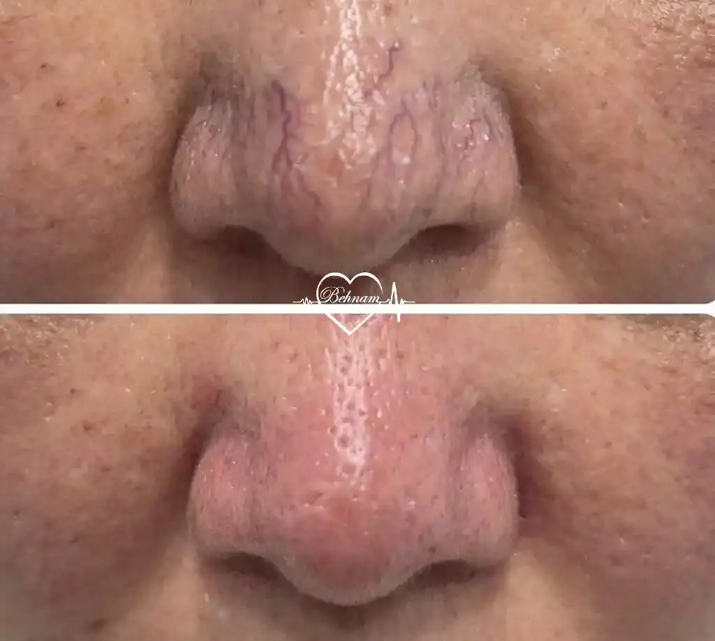 واریس بینی صورت