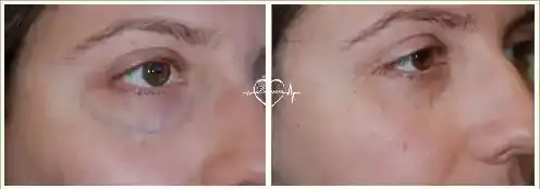 واریس صورت زیر چشم