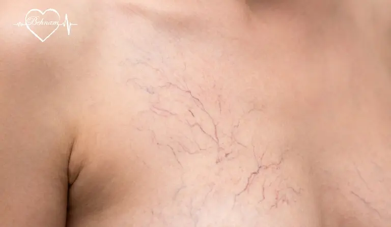 واریس عنکبوتی سینه