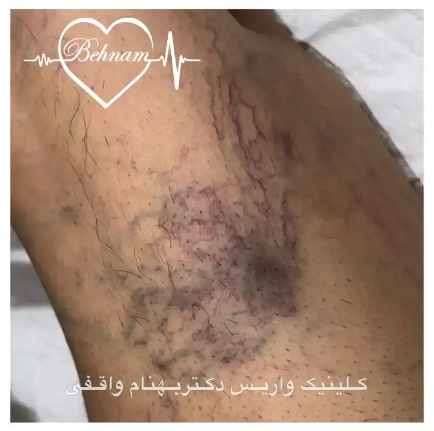 واریس عنکبوتی پشت زانو