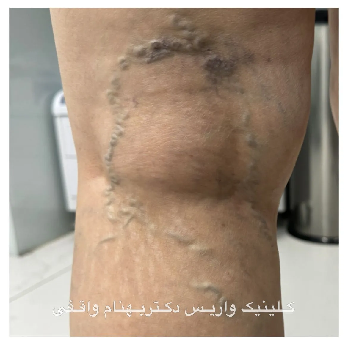 واریس مشبک یا شبکه ای یا رتیکولار