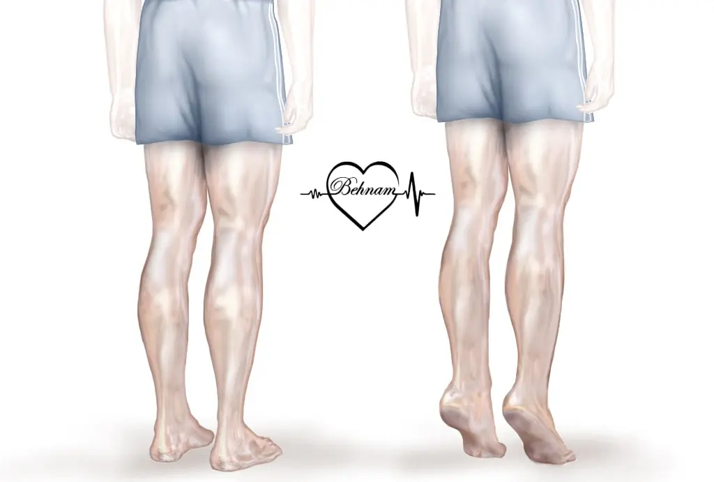 Varicose vein exercise