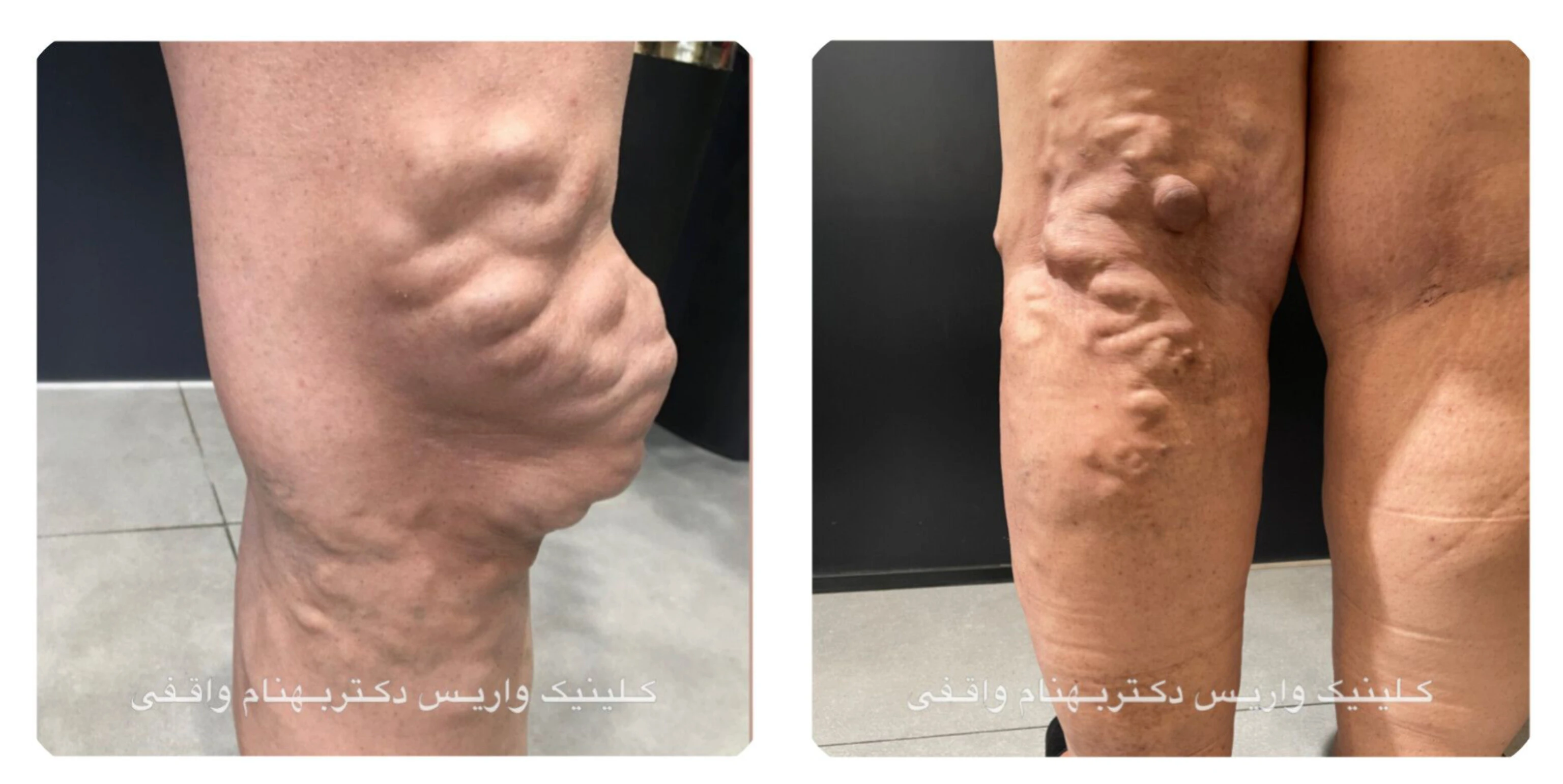 پیچ خوردگی رگ ها در واریس طنابی