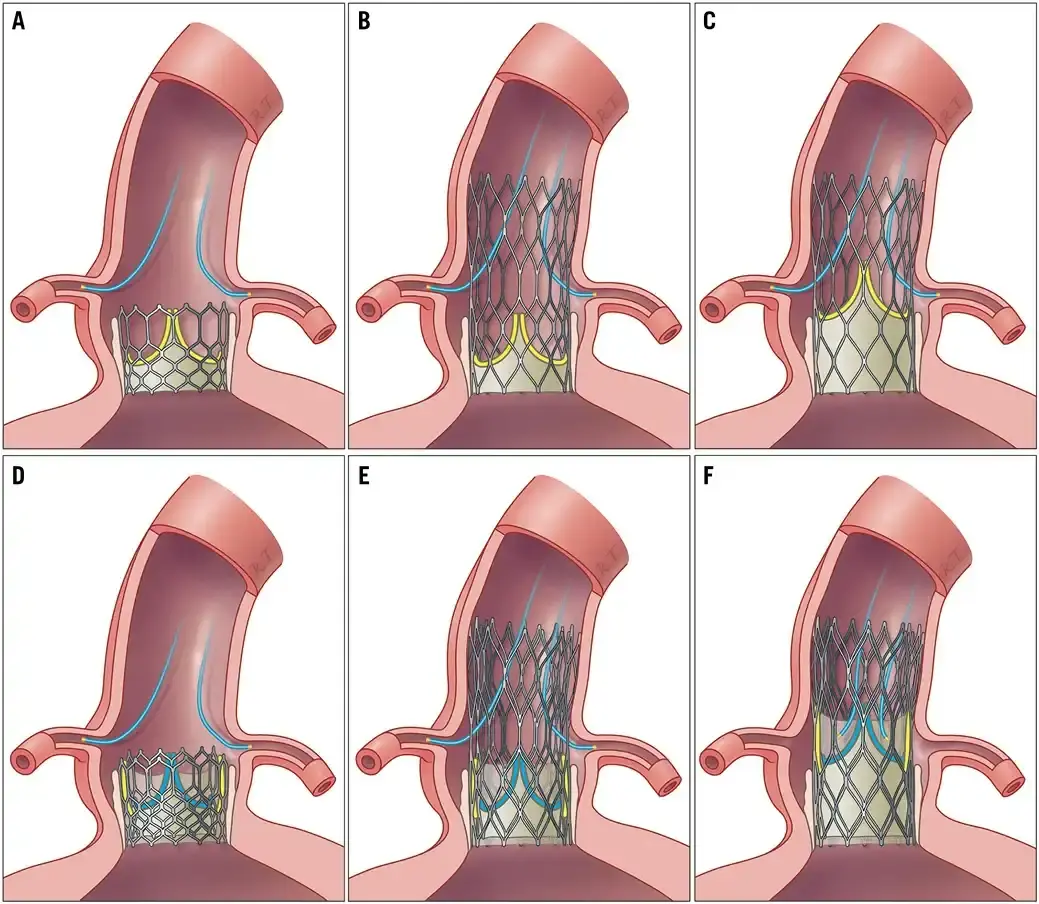 Aortic Valve Replacement tavi