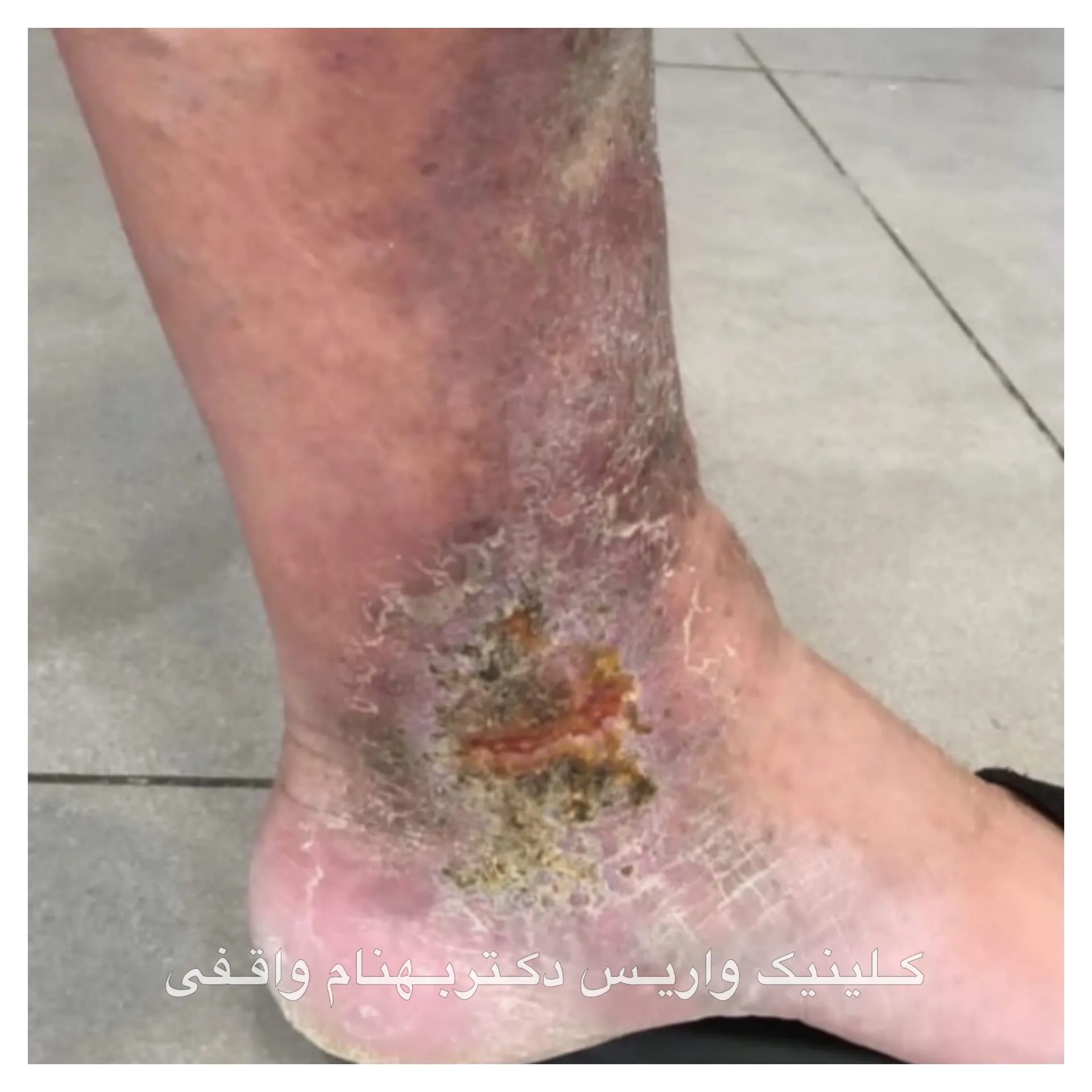 Frequently Asked Questions About Leg Varicose Veins
