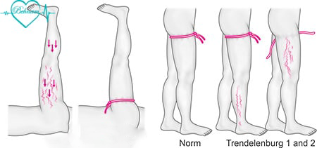 اختبار ترندلنبرغ لدوالی الساقین