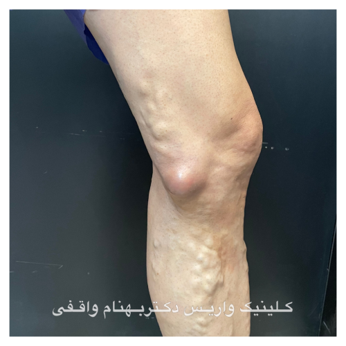 Truncal Varicose Veins
