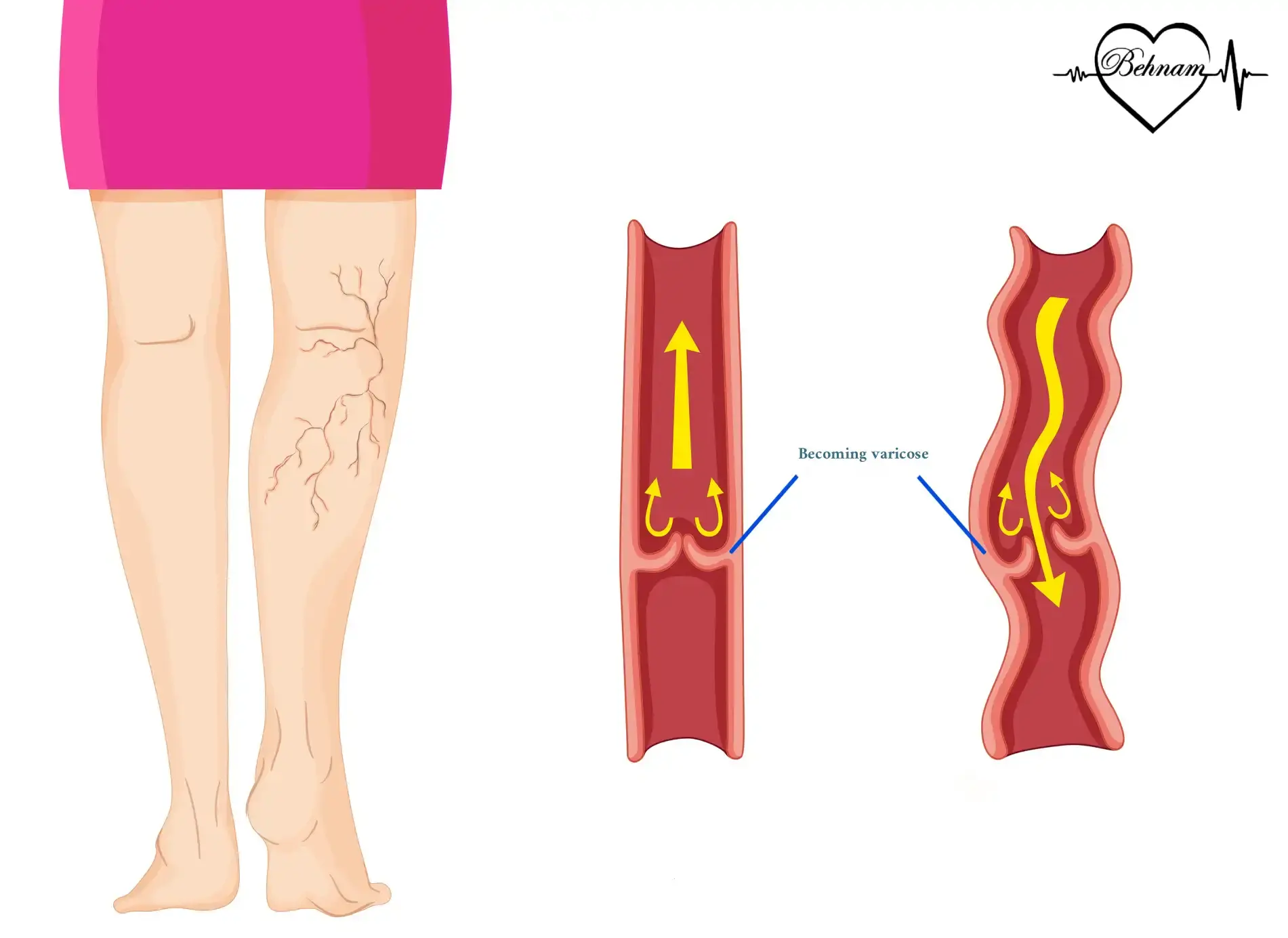 Varicose veins in the women