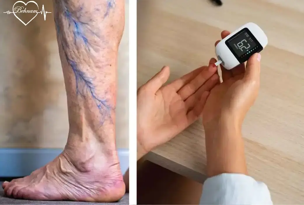 Varicose Vein & Diabetics