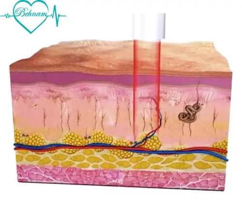 Simple laser treatment