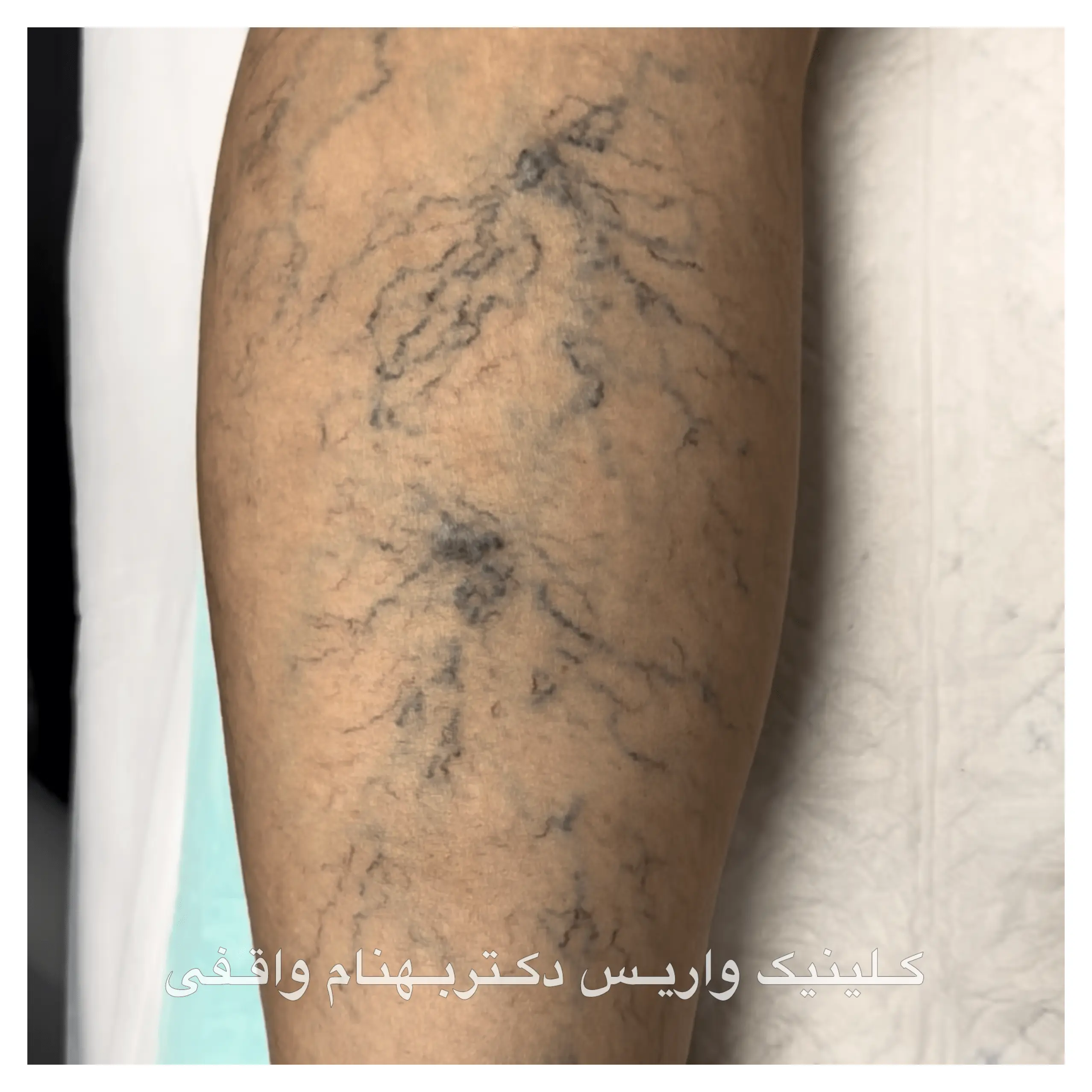 spider varicose veins