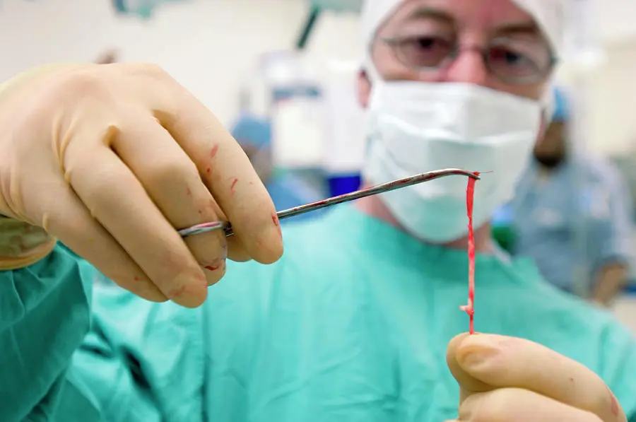 varicose vein surgery