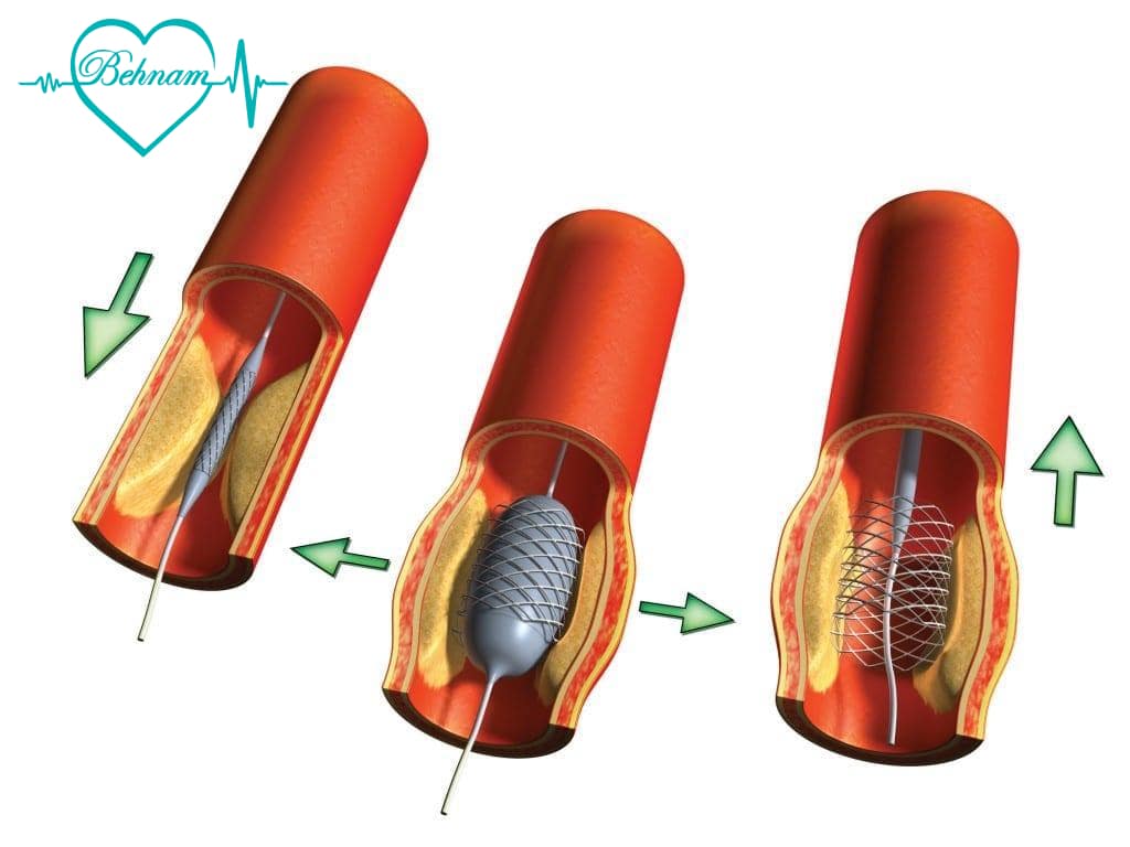 angioplasty