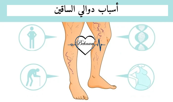 أسباب دوالي الساقين