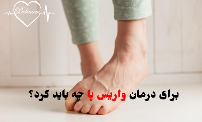 برای درمان واریس پا چه کنیم