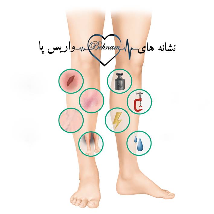 علائم واریس پا چیست