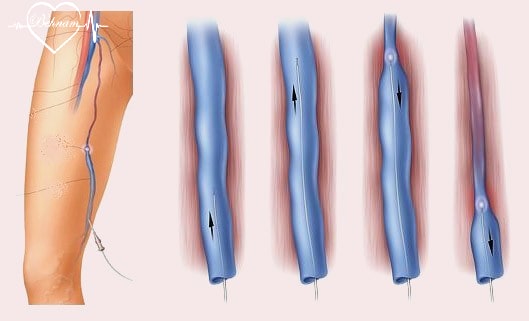 Endovenous Laser Varicose Vein Surgery