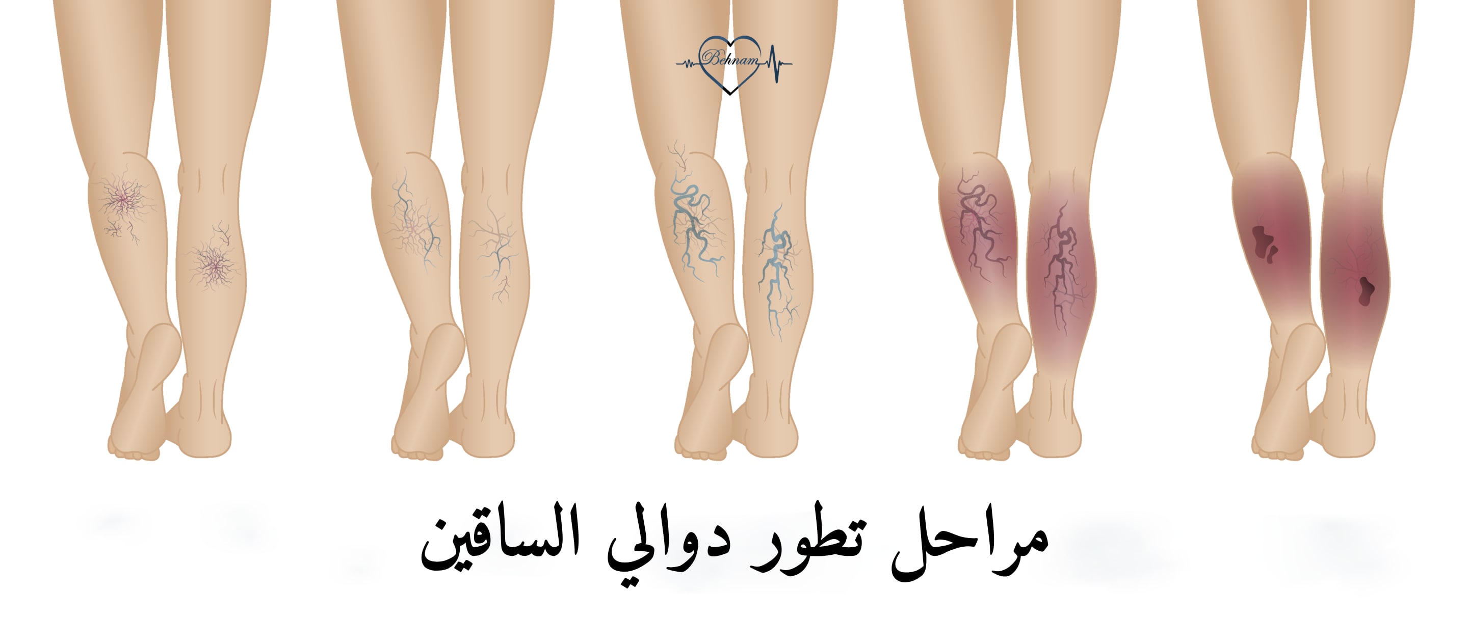 مراحل تطور دوالي الساقين
