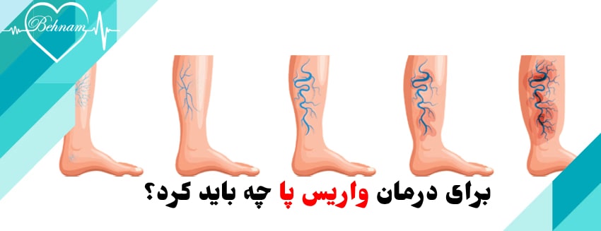مراحل پیشرفت واریس پا