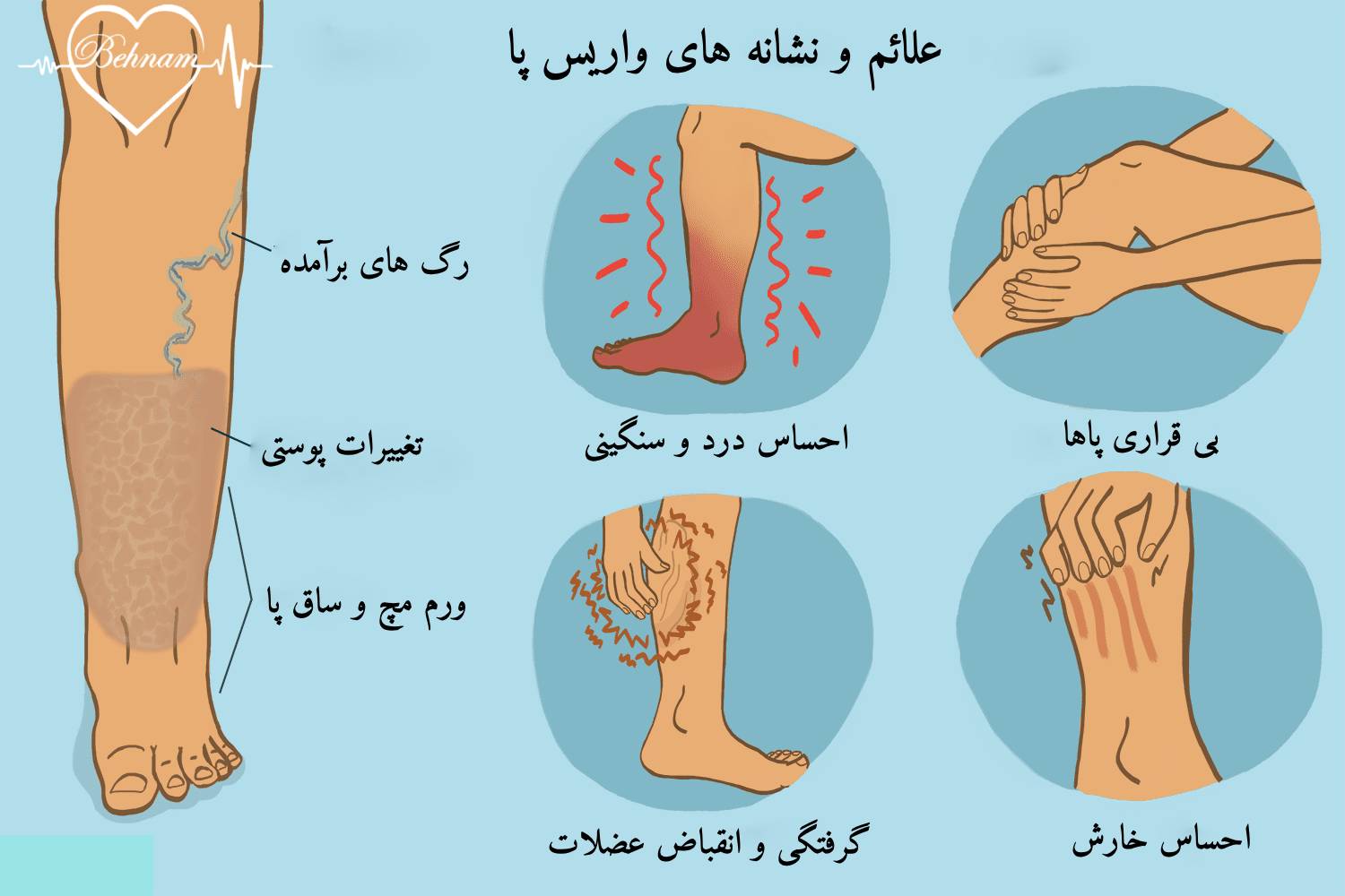 علائم واریس پا