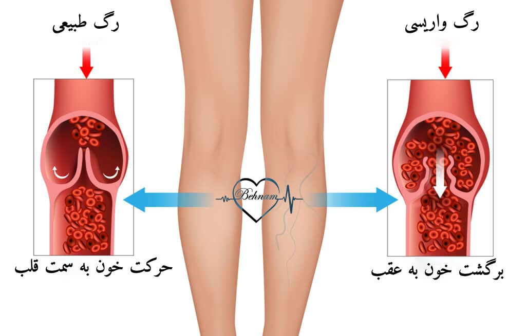 فرق واریس پا با رماتیسم