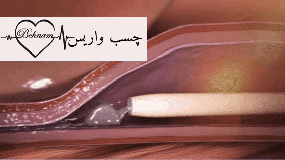 چسب وناسیل برای واریس چیست