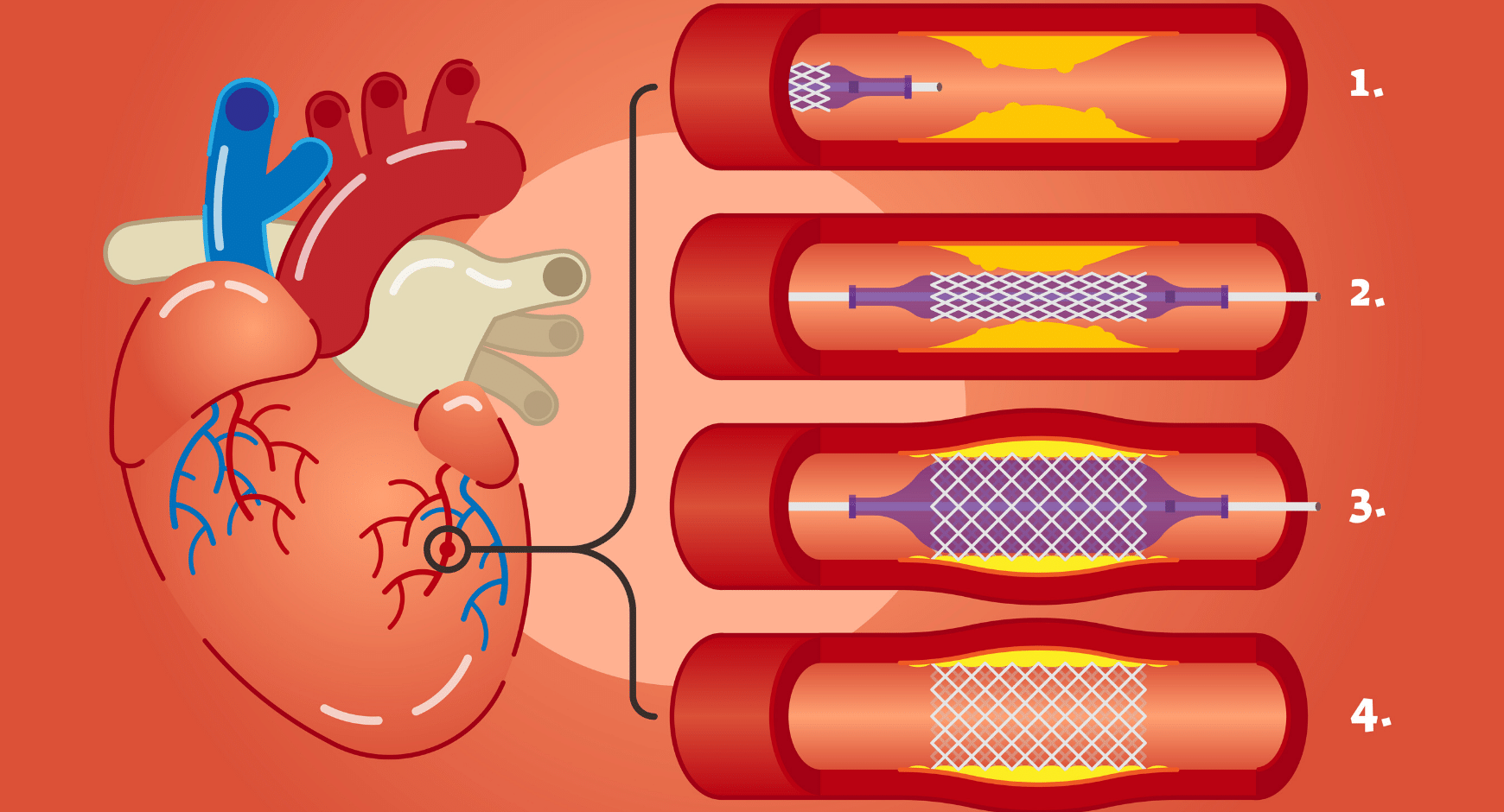 angiograghy