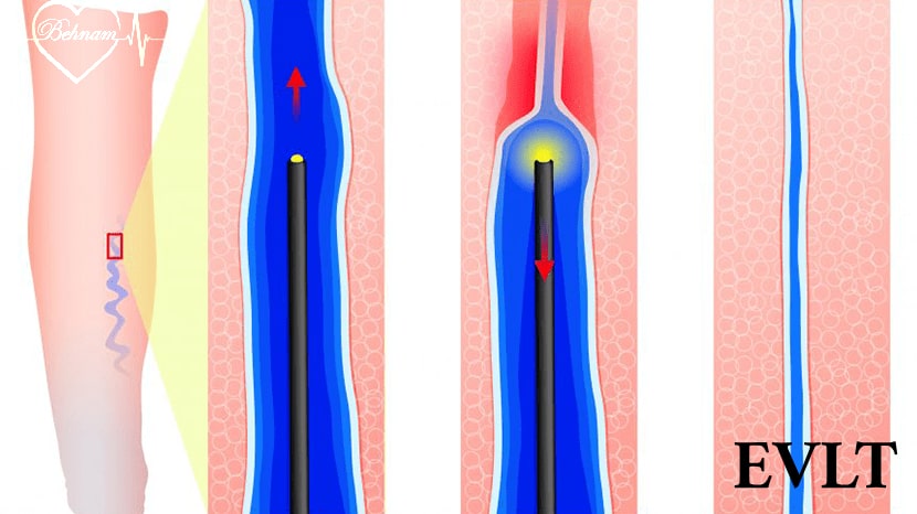 Endovenous Laser Treatment