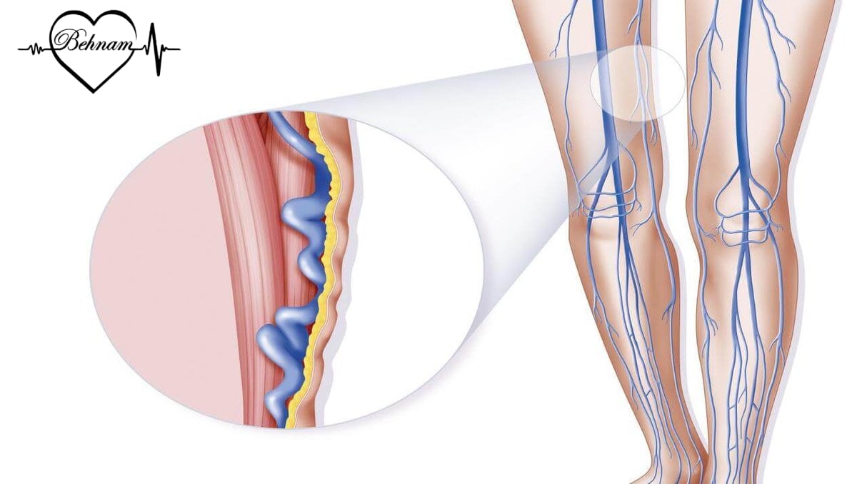 Hidden and deep varicose veins in the leg