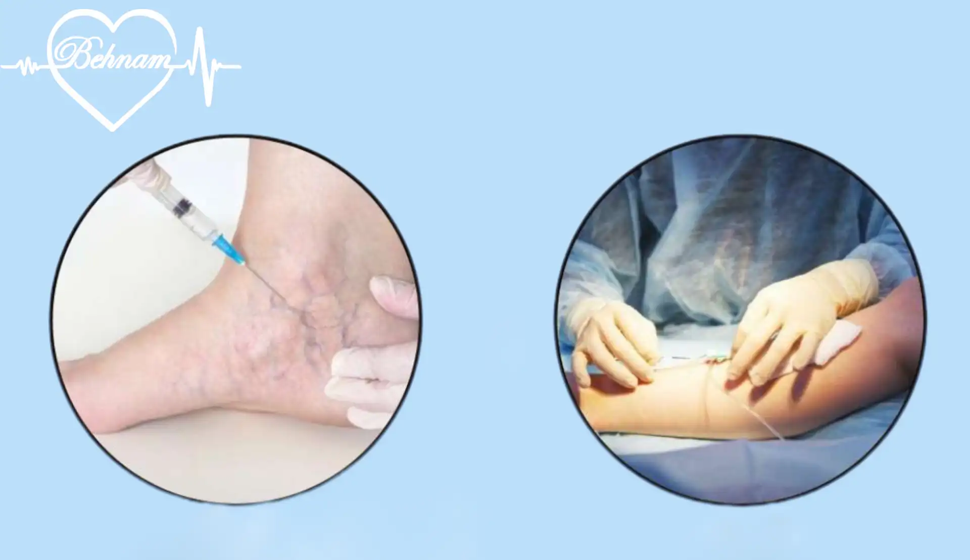 Laser or sclerotherapy for leg varicose veins