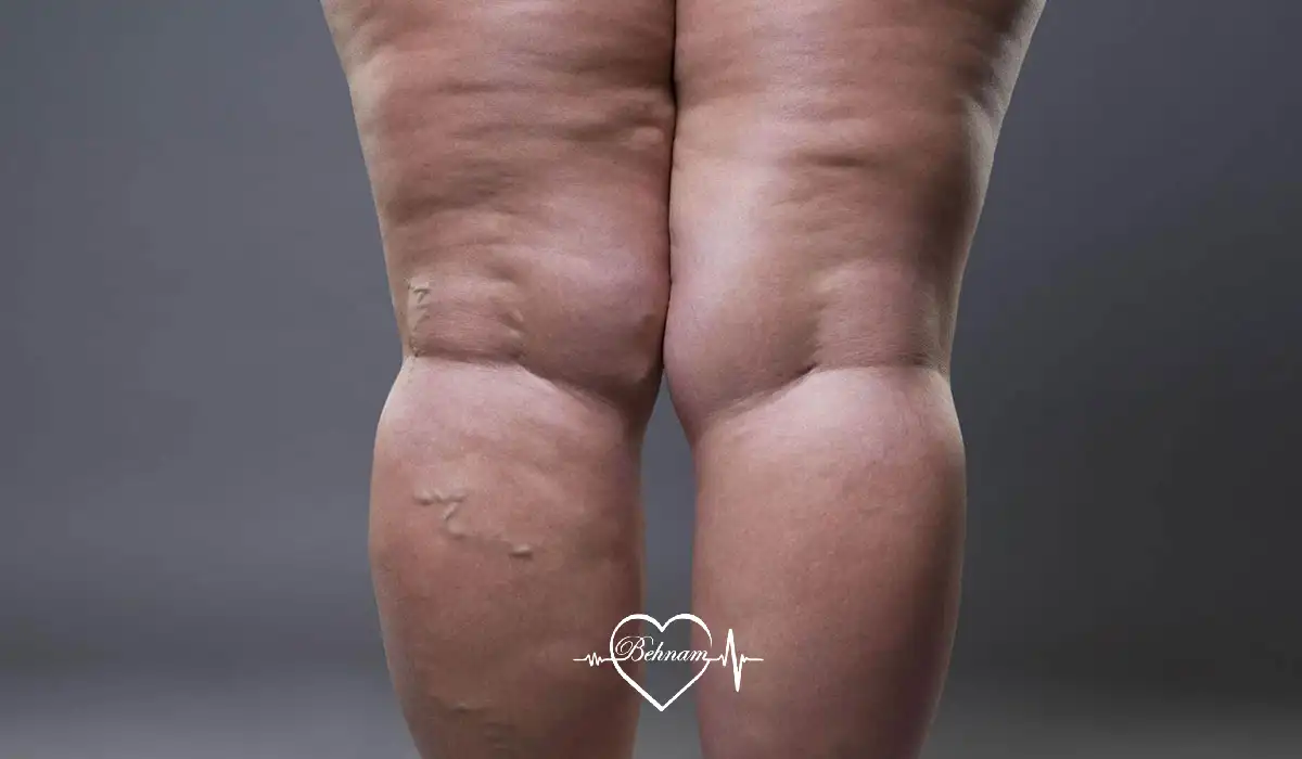 Obesity and leg varicose veins