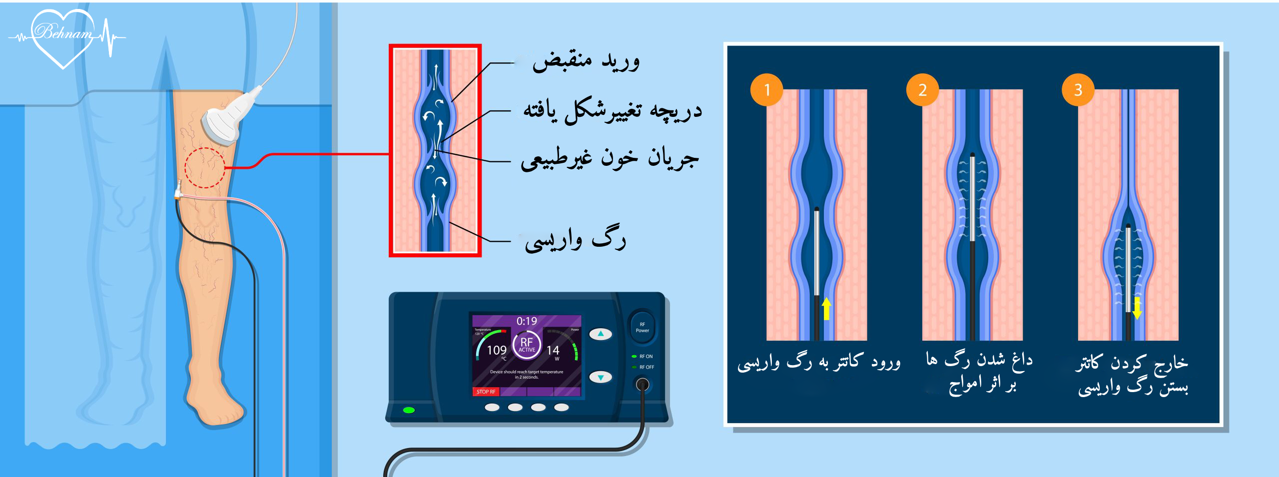 درمان واریس پا با رادیوفرکانسی RF
