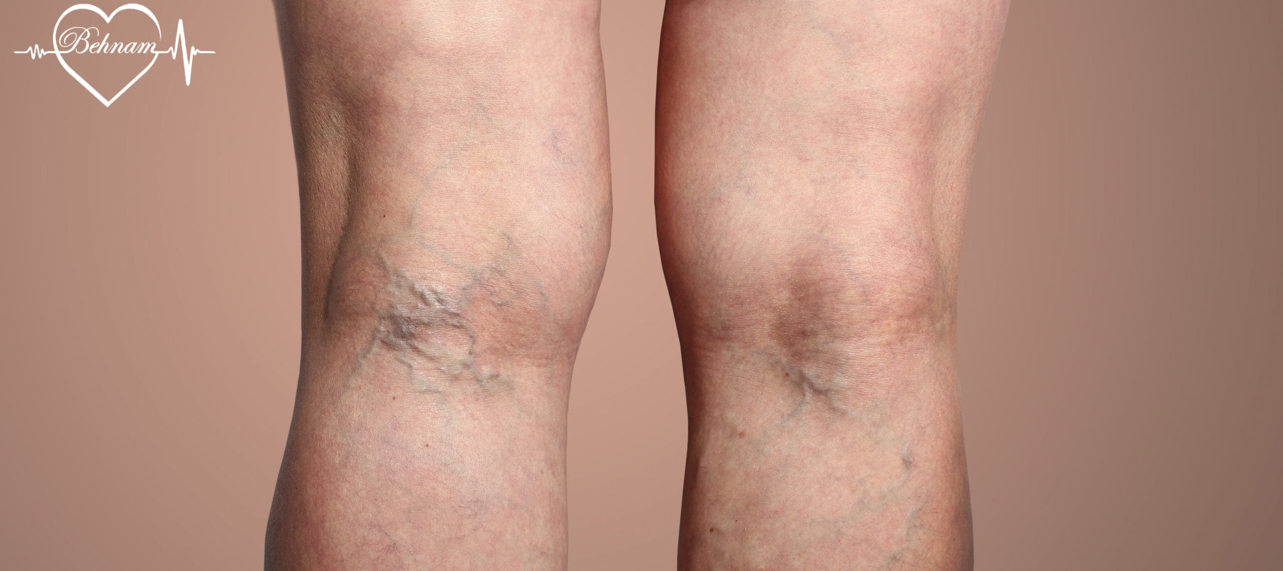 ReticularVeins