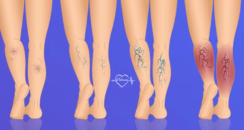 Reticular varicose veins