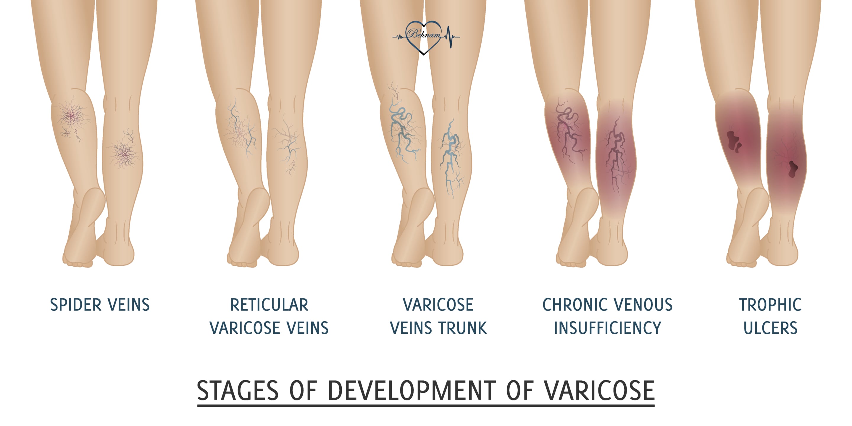 Severity of Varicose Veins