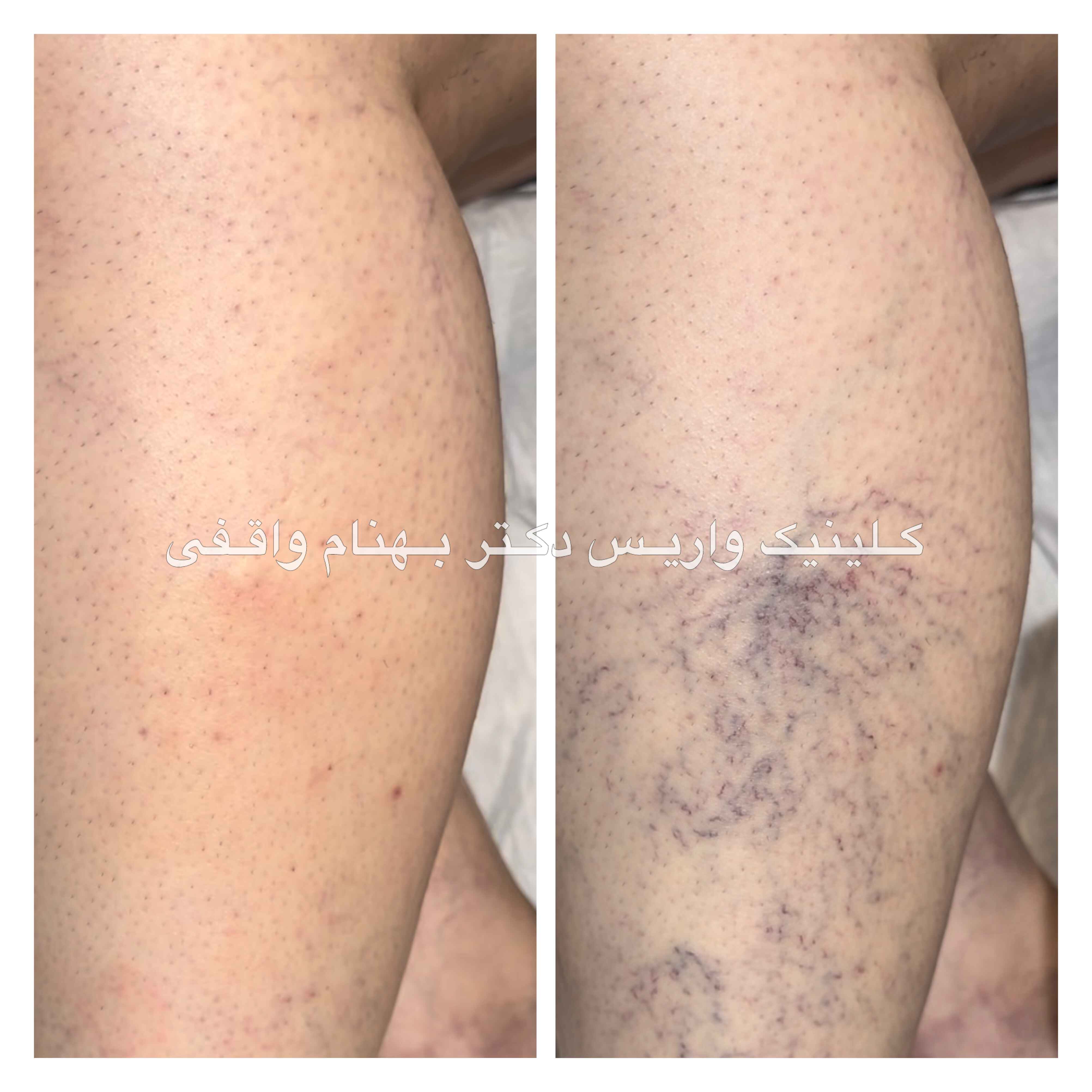 Spider varicose veins treatment