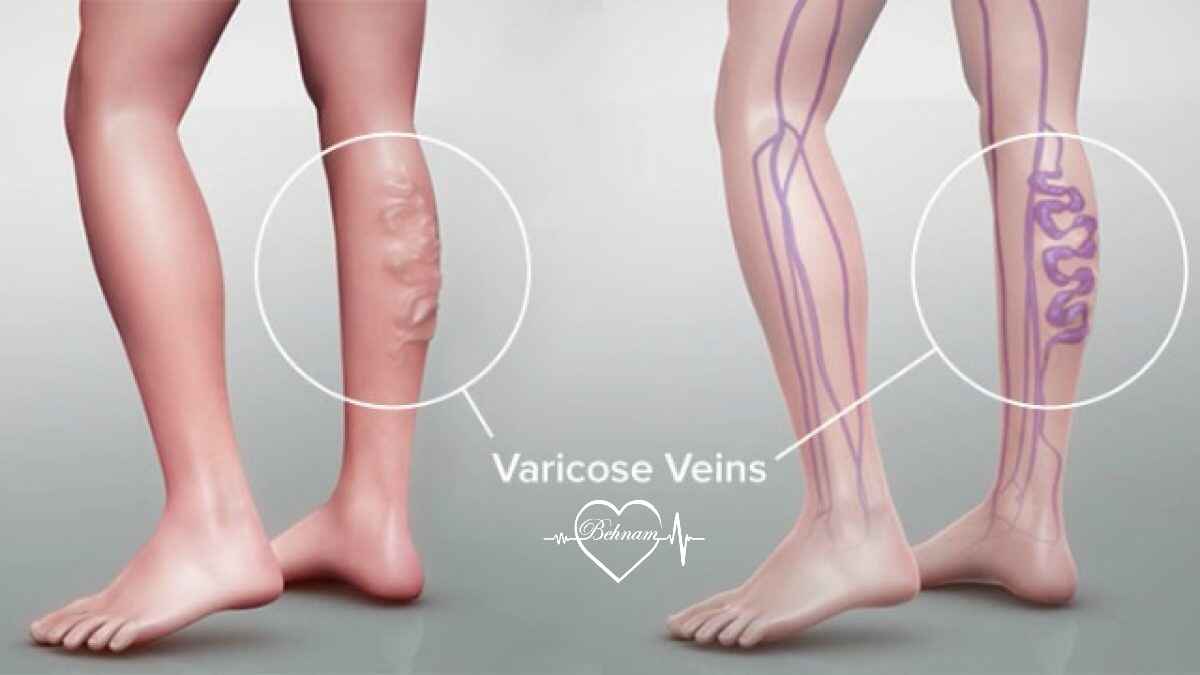 Stages of leg varicose vein treatment