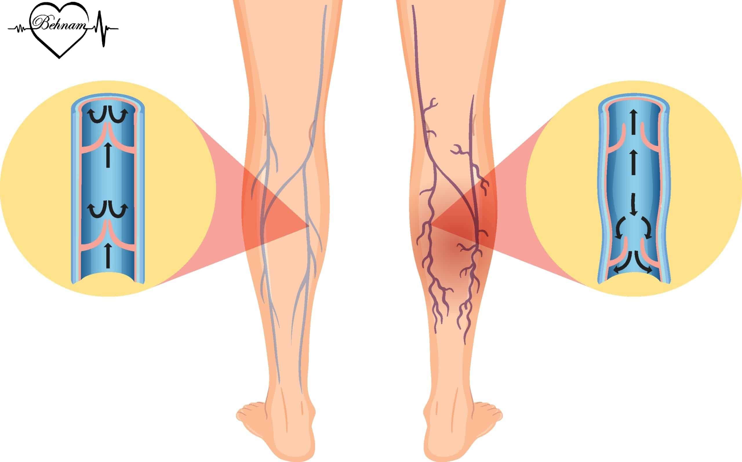 The impact of heat on leg varices.