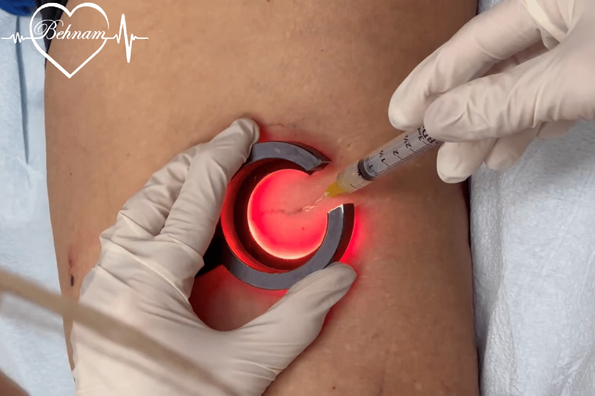 Varicose vein treatment