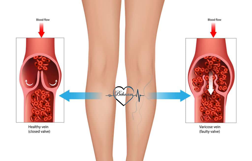 The difference between varicose veins and rheumatism