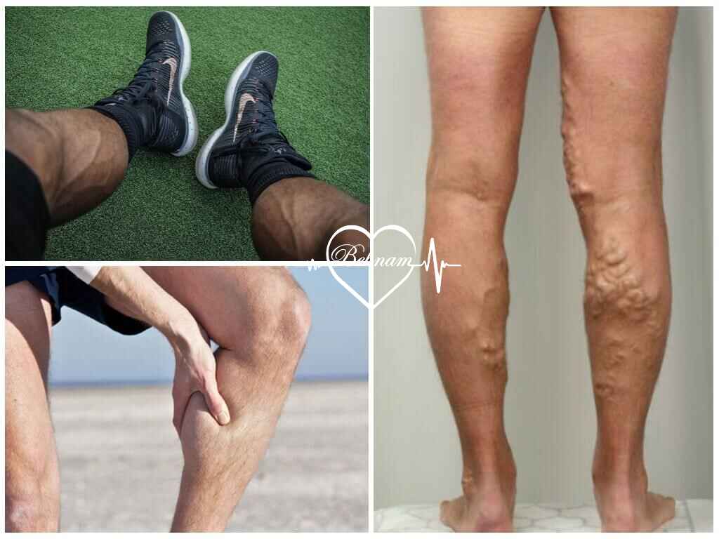 Varicose veins in men